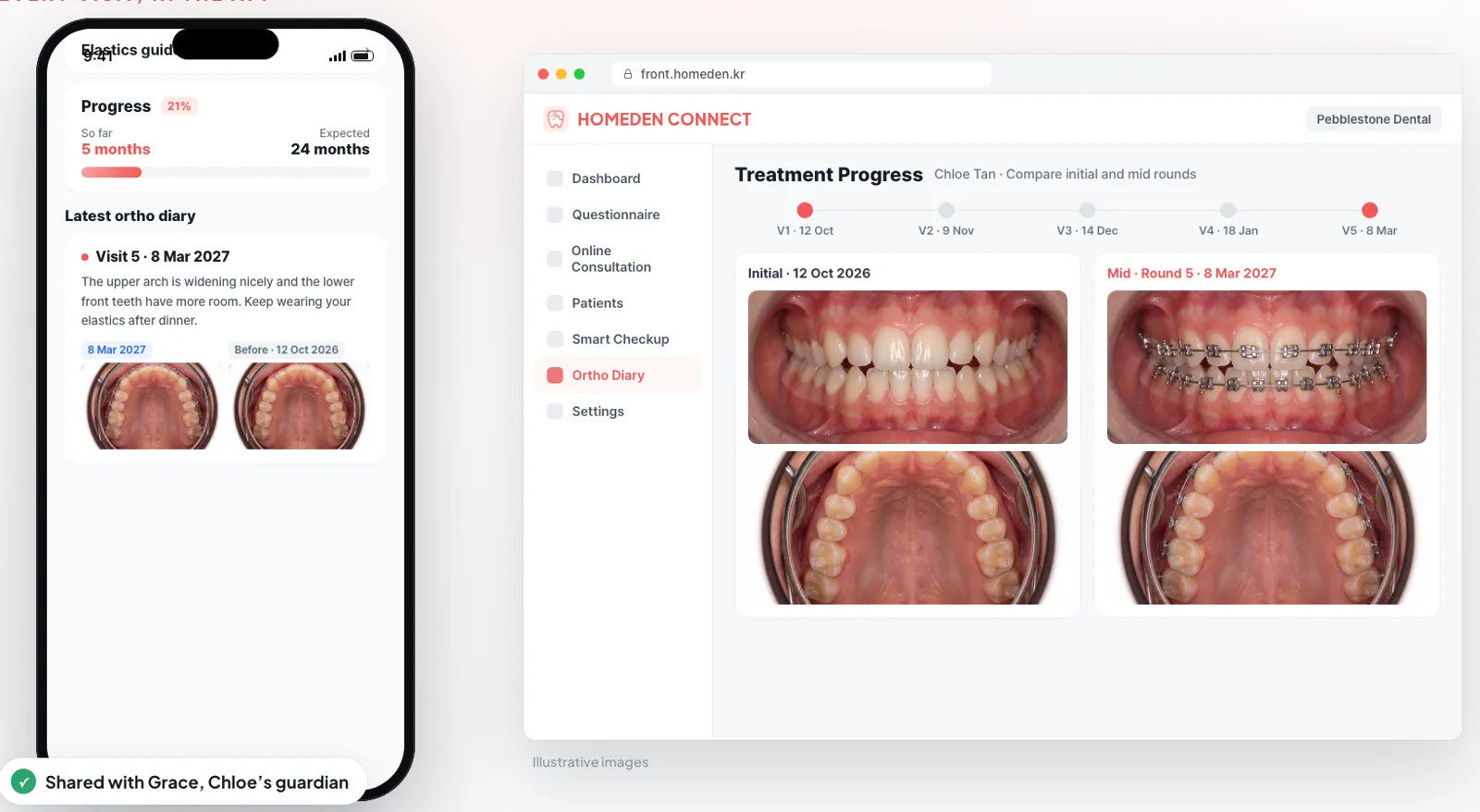 Example: the patient's ortho diary on the phone shows progress and the latest visit note, beside the clinic's treatment progress screen comparing the first visit with the latest one